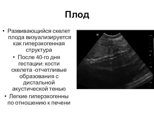 Плод Развивающийся скелет плода визуализируется как гиперэхогенная структура После 40-го дня гестации: