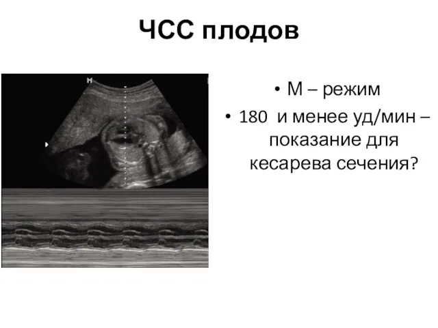 ЧСС плодов М – режим 180 и менее уд/мин – показание для кесарева сечения?