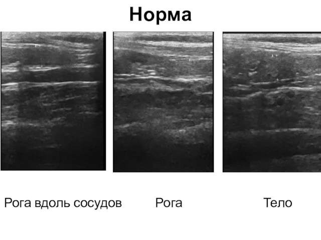 Норма Рога вдоль сосудов Рога Тело