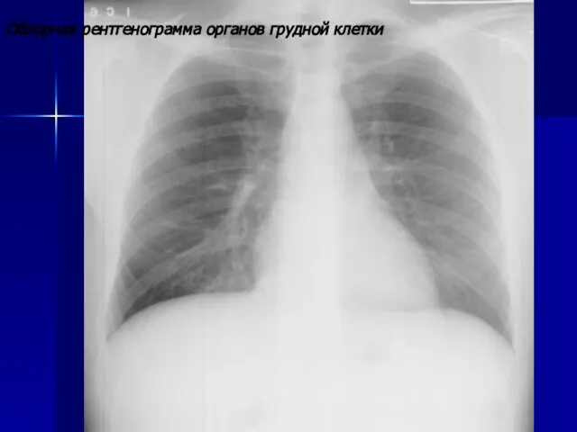 Обзорная рентгенограмма органов грудной клетки