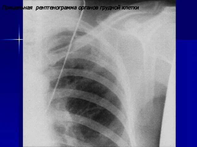 Прицельная рентгенограмма органов грудной клетки