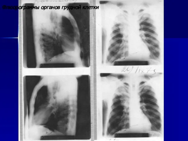 Флюорограммы органов грудной клетки