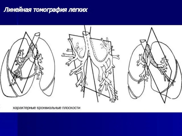 Линейная томография легких