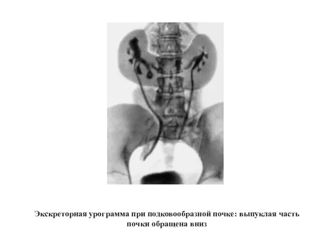 Экскреторная урограмма при подковообразной почке: выпуклая часть почки обращена вниз