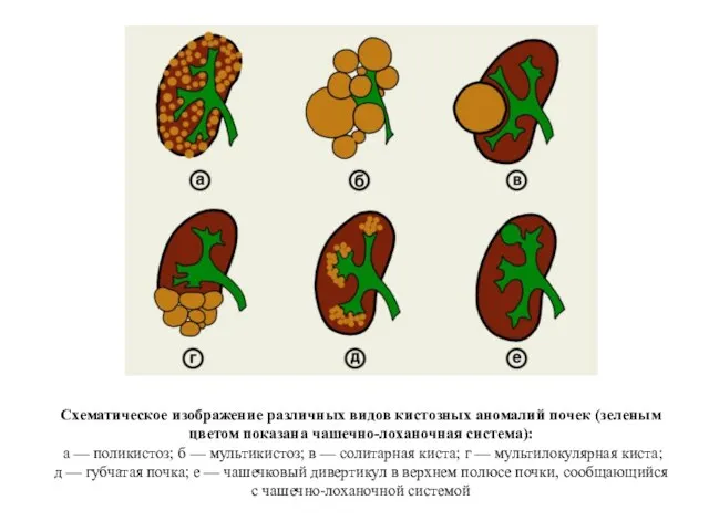 Схематическое изображение различных видов кистозных аномалий почек (зеленым цветом показана чашечно-лоханочная система):