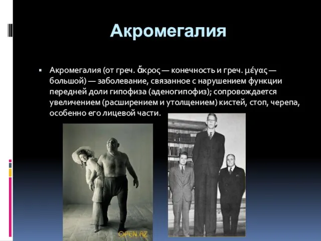 Акромегалия Акромегалия (от греч. ἄκρος — конечность и греч. μέγας — большой)