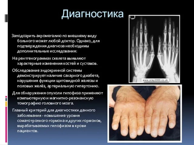 Диагностика Заподозрить акромегалию по внешнему виду больного может любой доктор. Однако, для