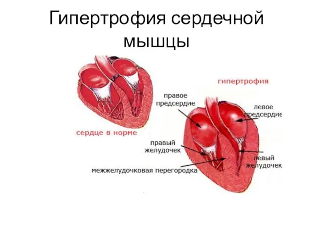 Гипертрофия сердечной мышцы