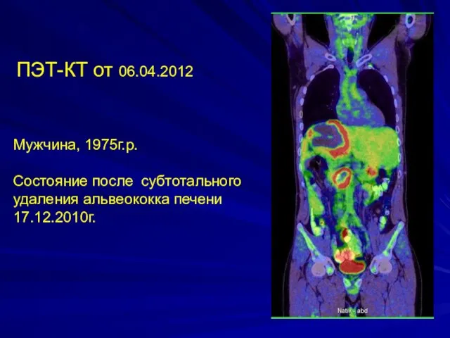 ПЭТ-КТ от 06.04.2012 Мужчина, 1975г.р. Состояние после субтотального удаления альвеококка печени 17.12.2010г.