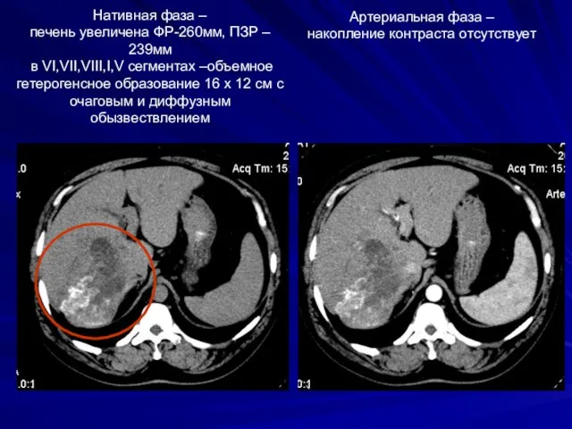 Нативная фаза – печень увеличена ФР-260мм, ПЗР – 239мм в VI,VII,VIII,I,V сегментах