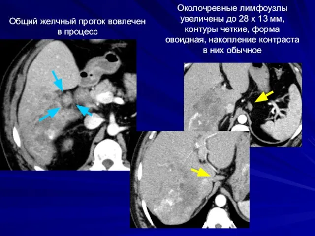 Общий желчный проток вовлечен в процесс Околочревные лимфоузлы увеличены до 28 х