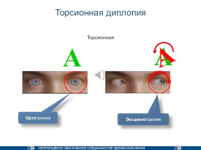 Торсионная диплопия Торсионная А А А Эксциклотропия Ортотропия