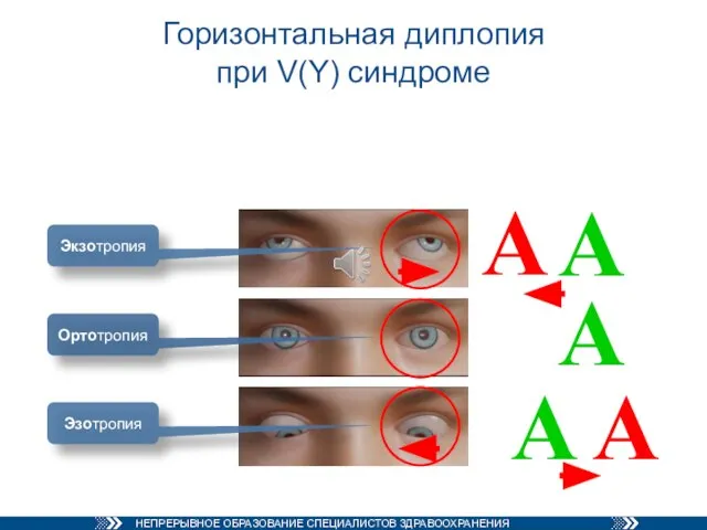 Горизонтальная диплопия при V(Y) синдроме А А А А А Экзотропия Ортотропия Эзотропия