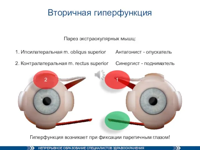Вторичная гиперфункция Парез экстраокулярных мышц: 1 2 Гиперфункция возникает при фиксации паретичным глазом!