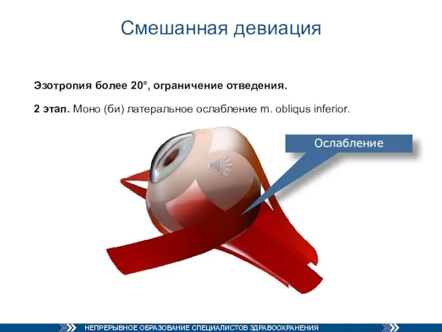 Смешанная девиация Эзотропия более 20°, ограничение отведения. 2 этап. Моно (би) латеральное