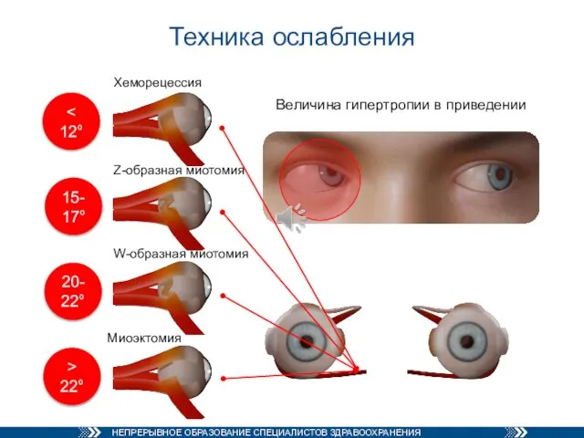 Техника ослабления Величина гипертропии в приведении Z-образная миотомия W-образная миотомия Миоэктомия Хеморецессия