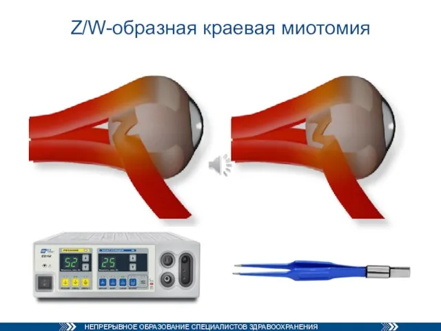 Z/W-образная краевая миотомия