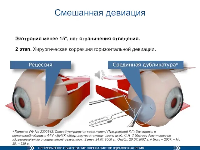 Смешанная девиация Эзотропия менее 15°, нет ограничения отведения. 2 этап. Хирургическая коррекция