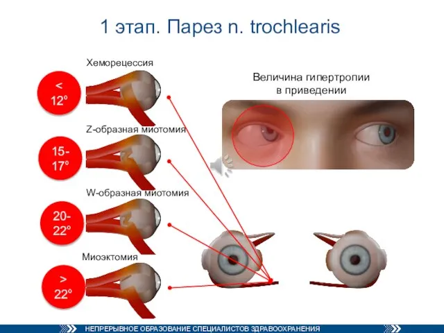 1 этап. Парез n. trochlearis Величина гипертропии в приведении Z-образная миотомия W-образная