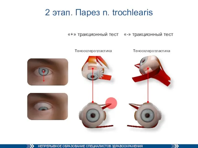 2 этап. Парез n. trochlearis «+» тракционный тест «-» тракционный тест