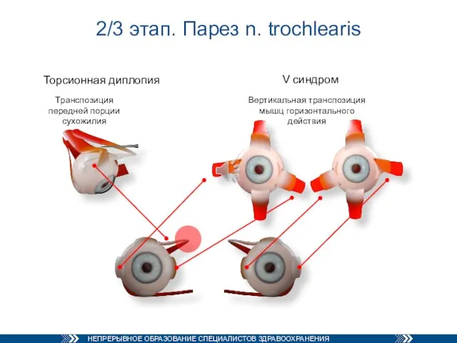 2/3 этап. Парез n. trochlearis Торсионная диплопия V синдром