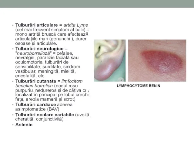 Tulburări articulare = artrita Lyme (cel mai frecvent simptom al bolii) =