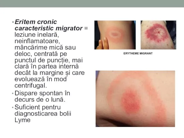 Eritem cronic caracteristic migrator = leziune inelară, neinflamatoare, mâncărime mică sau deloc,