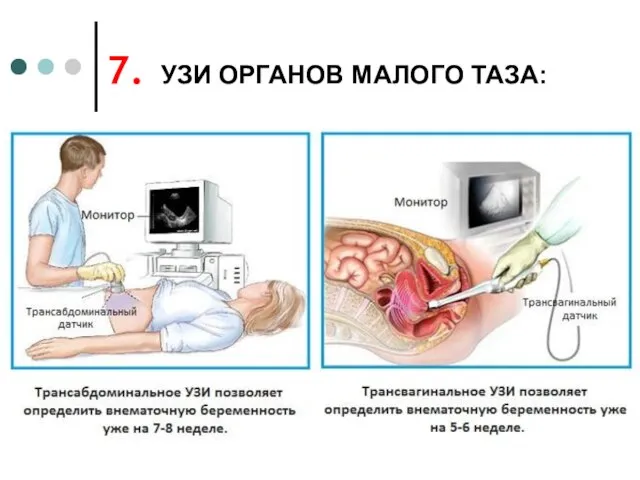 УЗИ ОРГАНОВ МАЛОГО ТАЗА: