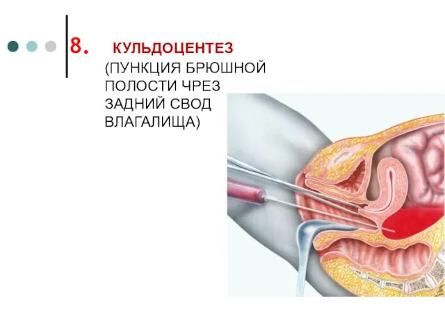 КУЛЬДОЦЕНТЕЗ (ПУНКЦИЯ БРЮШНОЙ ПОЛОСТИ ЧРЕЗ ЗАДНИЙ СВОД ВЛАГАЛИЩА)