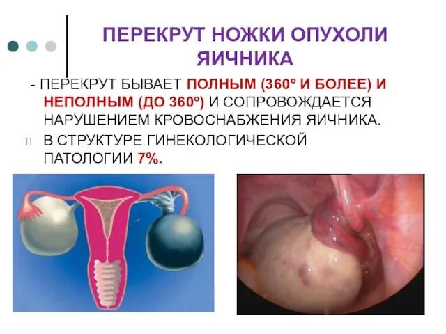 ПЕРЕКРУТ НОЖКИ ОПУХОЛИ ЯИЧНИКА - ПЕРЕКРУТ БЫВАЕТ ПОЛНЫМ (360º И БОЛЕЕ) И