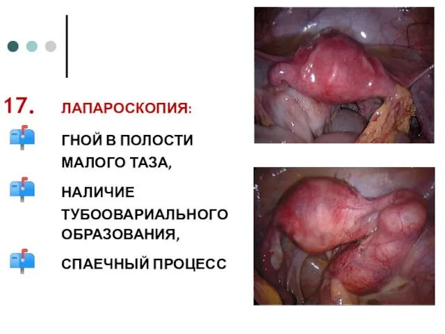 ЛАПАРОСКОПИЯ: ГНОЙ В ПОЛОСТИ МАЛОГО ТАЗА, НАЛИЧИЕ ТУБООВАРИАЛЬНОГО ОБРАЗОВАНИЯ, СПАЕЧНЫЙ ПРОЦЕСС