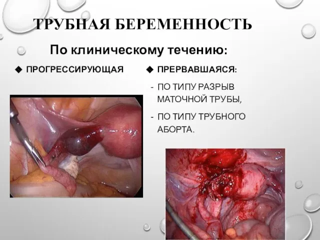 ТРУБНАЯ БЕРЕМЕННОСТЬ ПРОГРЕССИРУЮЩАЯ ПРЕРВАВШАЯСЯ: ПО ТИПУ РАЗРЫВ МАТОЧНОЙ ТРУБЫ, ПО ТИПУ ТРУБНОГО АБОРТА. По клиническому течению: