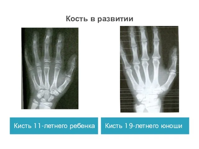 Кость в развитии Кисть 11-летнего ребенка Кисть 19-летнего юноши