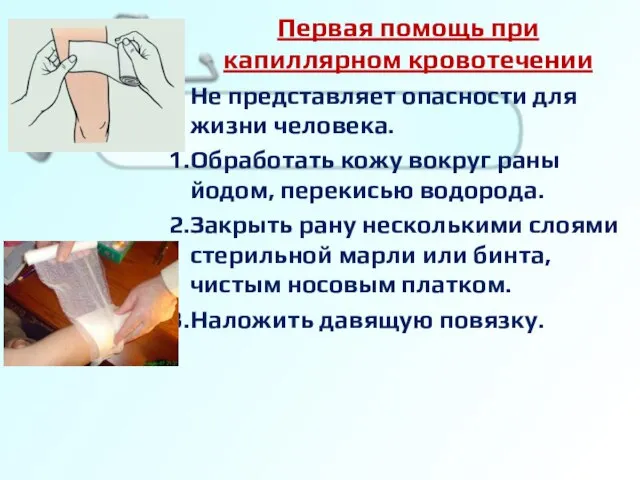 Первая помощь при капиллярном кровотечении Не представляет опасности для жизни человека. Обработать