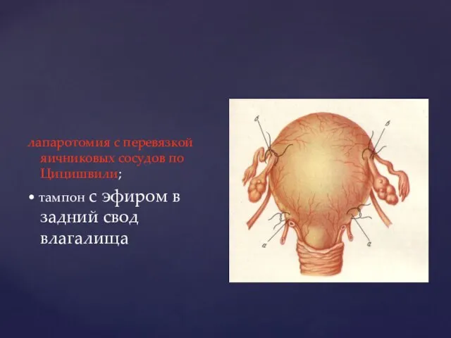 лапаротомия с перевязкой яичниковых сосудов по Цицишвили; • тампон с эфиром в задний свод влагалища