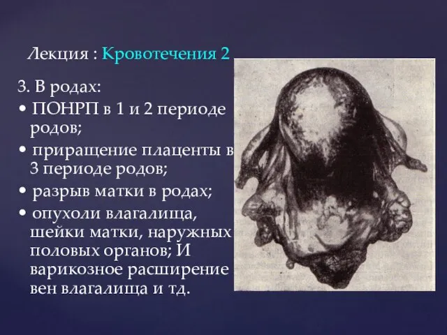 Лекция : Кровотечения 2 3. В родах: • ПОНРП в 1 и