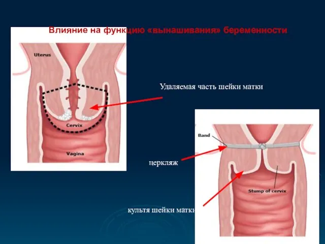 Влияние на функцию «вынашивания» беременности Удаляемая часть шейки матки культя шейки матки церкляж