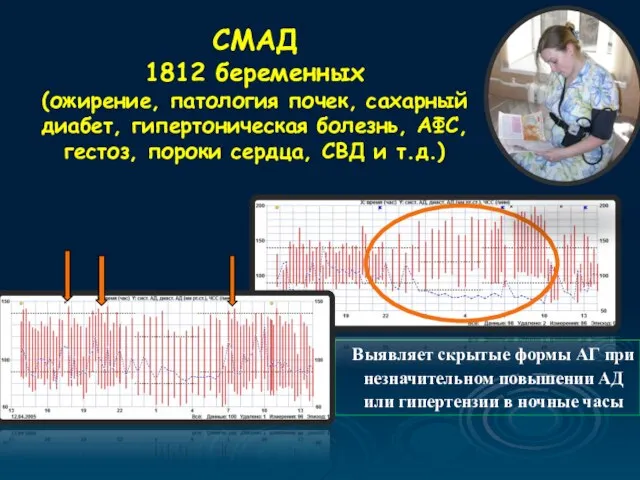 Выявляет скрытые формы АГ при незначительном повышении АД или гипертензии в ночные