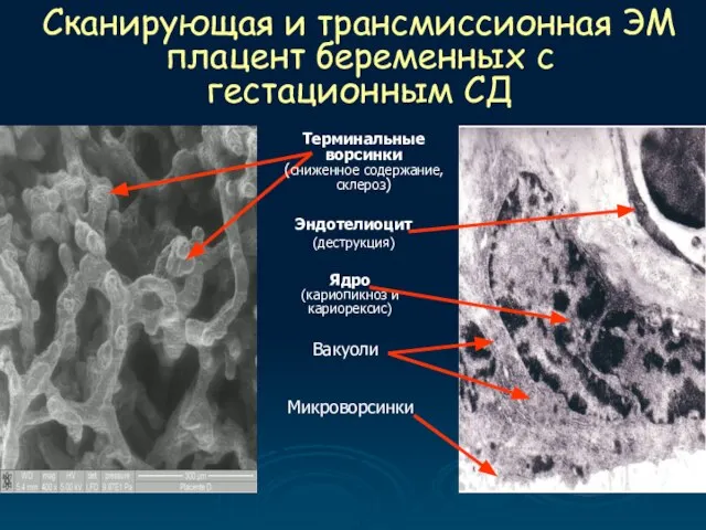 Сканирующая и трансмиссионная ЭМ плацент беременных с гестационным СД Ядро (кариопикноз и