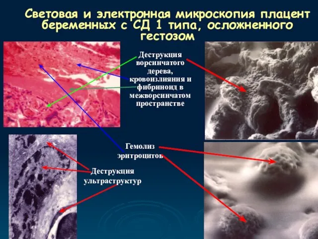 Световая и электронная микроскопия плацент беременных с СД 1 типа, осложненного гестозом