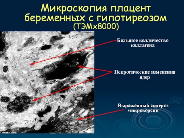 Микроскопия плацент беременных с гипотиреозом (ТЭМх8000) Некротические изменения ядер Выраженный склероз микроворсин Большое колличество коллагена