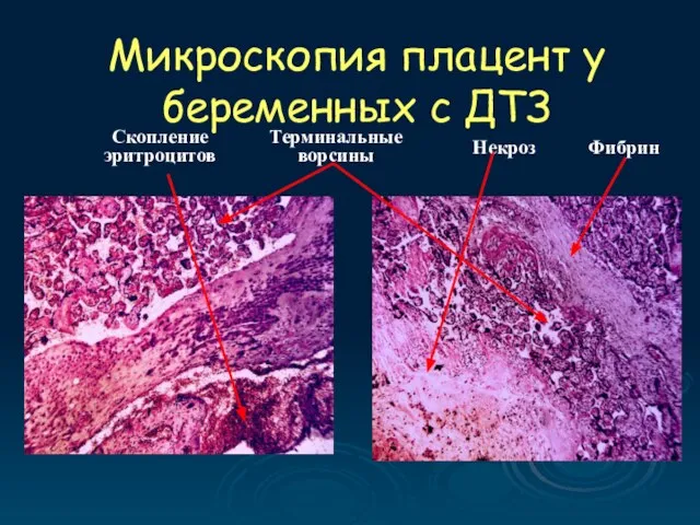 Микроскопия плацент у беременных с ДТЗ Фибрин Терминальные ворсины Некроз Скопление эритроцитов