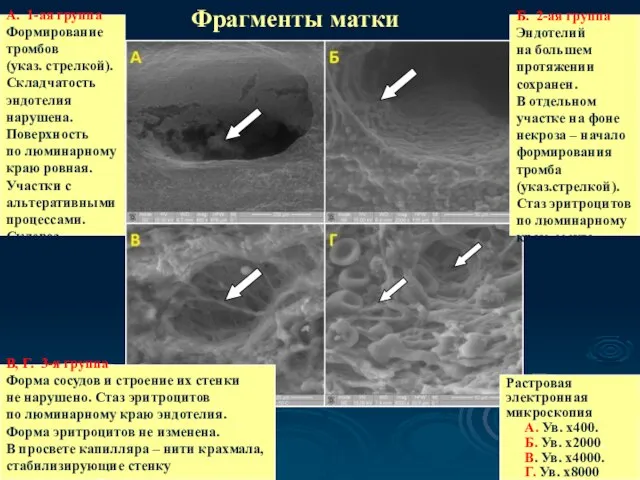 Фрагменты матки А. 1-ая группа Формирование тромбов (указ. стрелкой). Складчатость эндотелия нарушена.