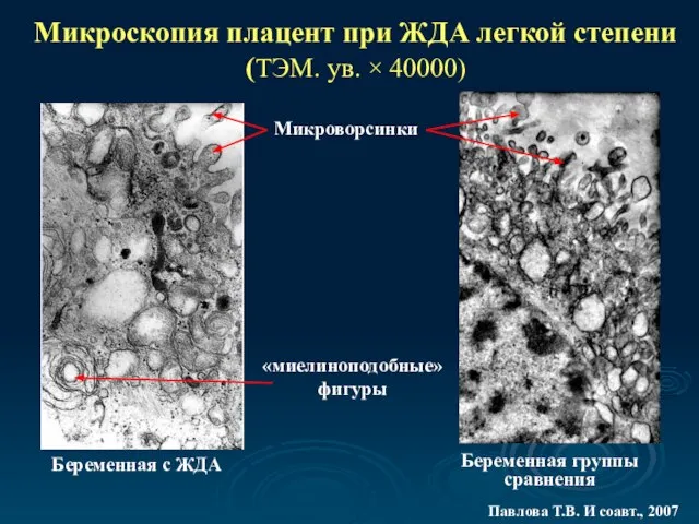 Микроскопия плацент при ЖДА легкой степени (ТЭМ. ув. × 40000) «миелиноподобные» фигуры