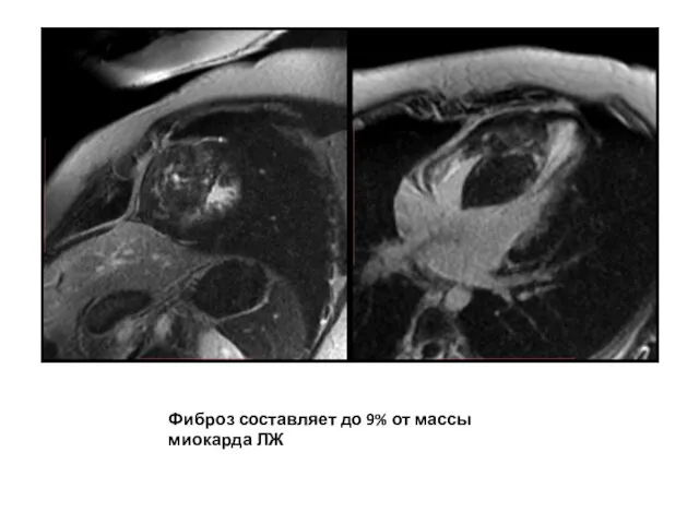 Фиброз составляет до 9% от массы миокарда ЛЖ