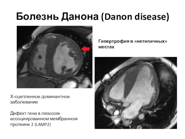 Болезнь Данона (Danon disease) Гипертрофия в «нетипичных» местах Х-сцепленное доминантное заболевание Дефект