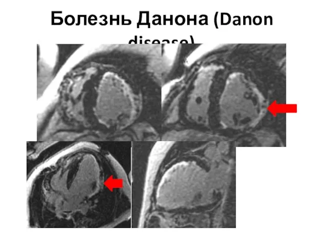 Болезнь Данона (Danon disease)