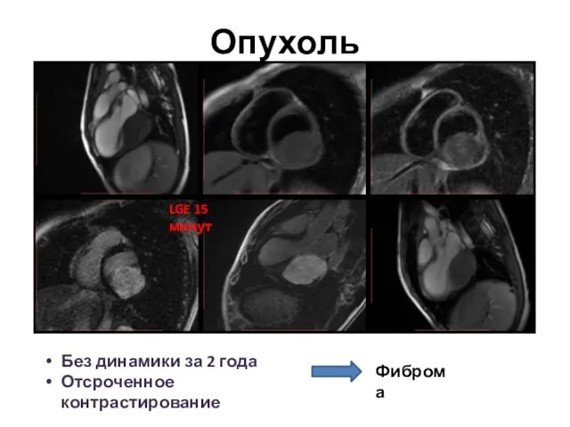 Опухоль Без динамики за 2 года Отсроченное контрастирование LGE 15 минут Фиброма