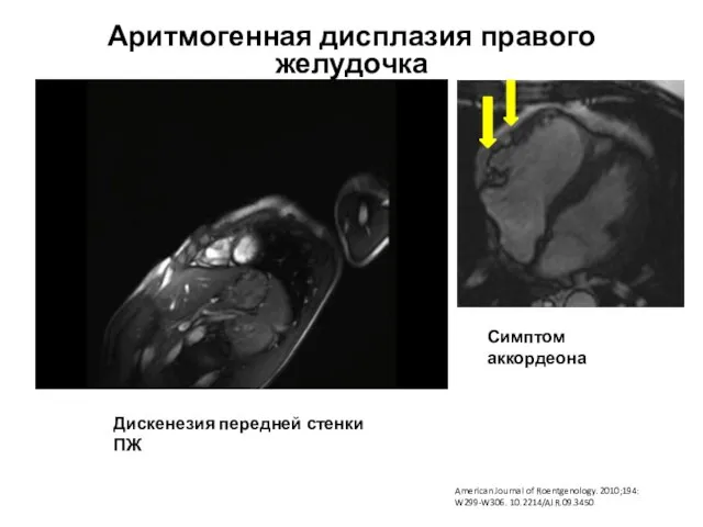 Аритмогенная дисплазия правого желудочка Дискенезия передней стенки ПЖ Симптом аккордеона American Journal