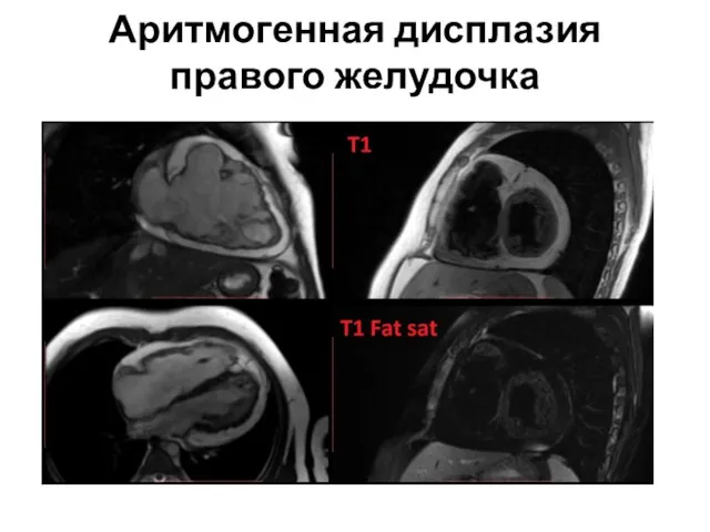 Аритмогенная дисплазия правого желудочка